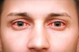 آلرژی چشمی